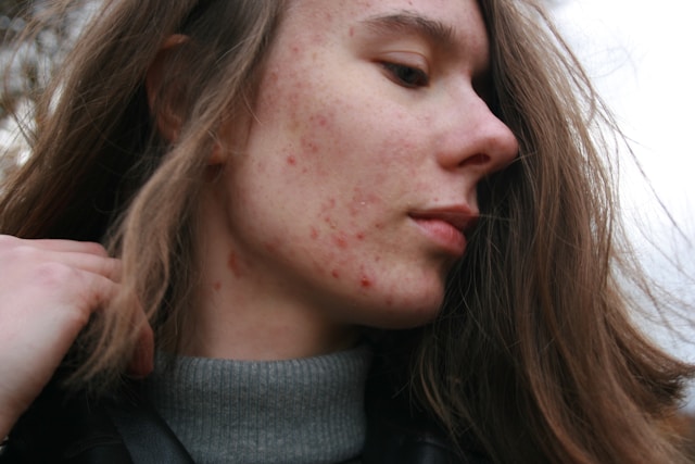 Finding The Best Acne Spot Treatment: Say Goodbye To Blemishes!