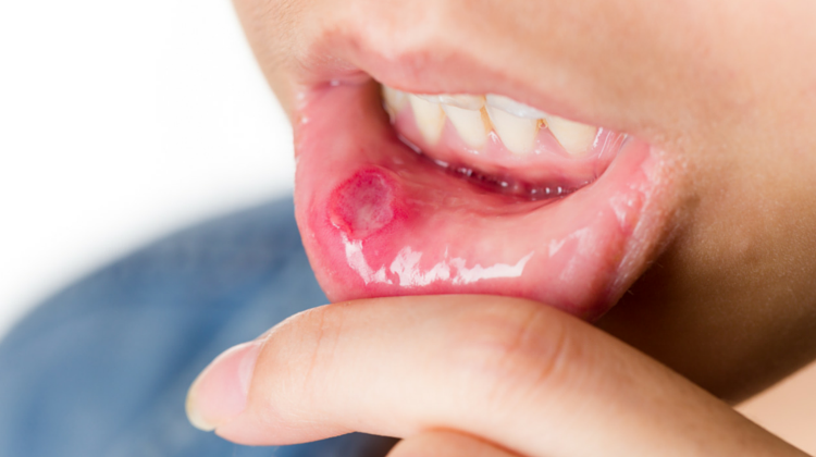 10 Super Simple Secrets for Healing Canker Sores (Naturally)