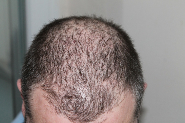 15 Most Powerful Remedies For Thinning Hair in the World