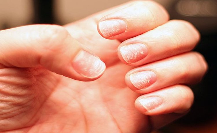 10 Home Remedies For Overcoming An Iron Deficiency