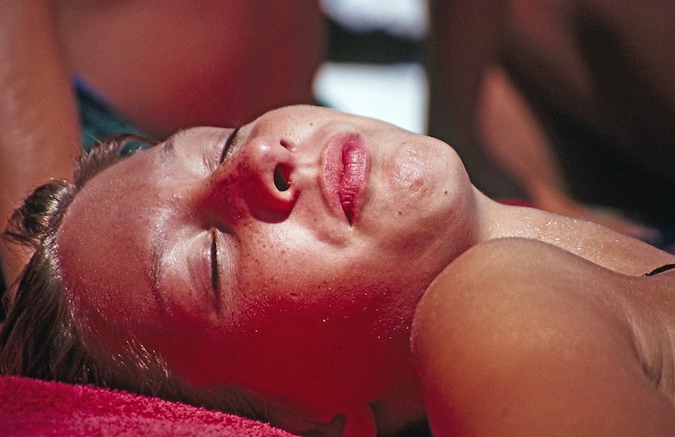 15 Ultra Relieving Sunburn Remedies That Really Work