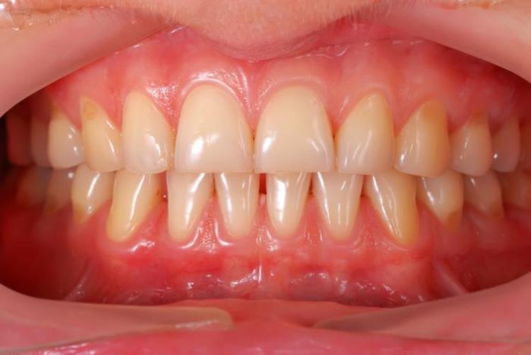 10 Home Remedies For Receding Gums That Help Them Grow Back Fast