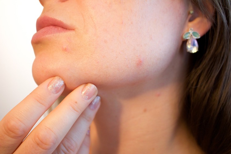 15 All Natural Home Remedies To Help Get Rid Of Acne