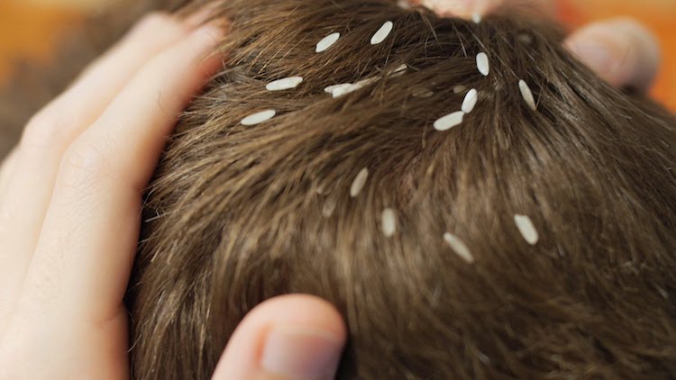 12 Natural Head Lice Remedies to Use at Home in 2026