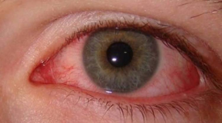 Have Pink Eyes? Here Are 10 Natural Pink Eye Remedies You Should Try