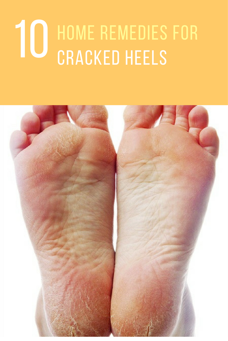 crack heel remedy at home