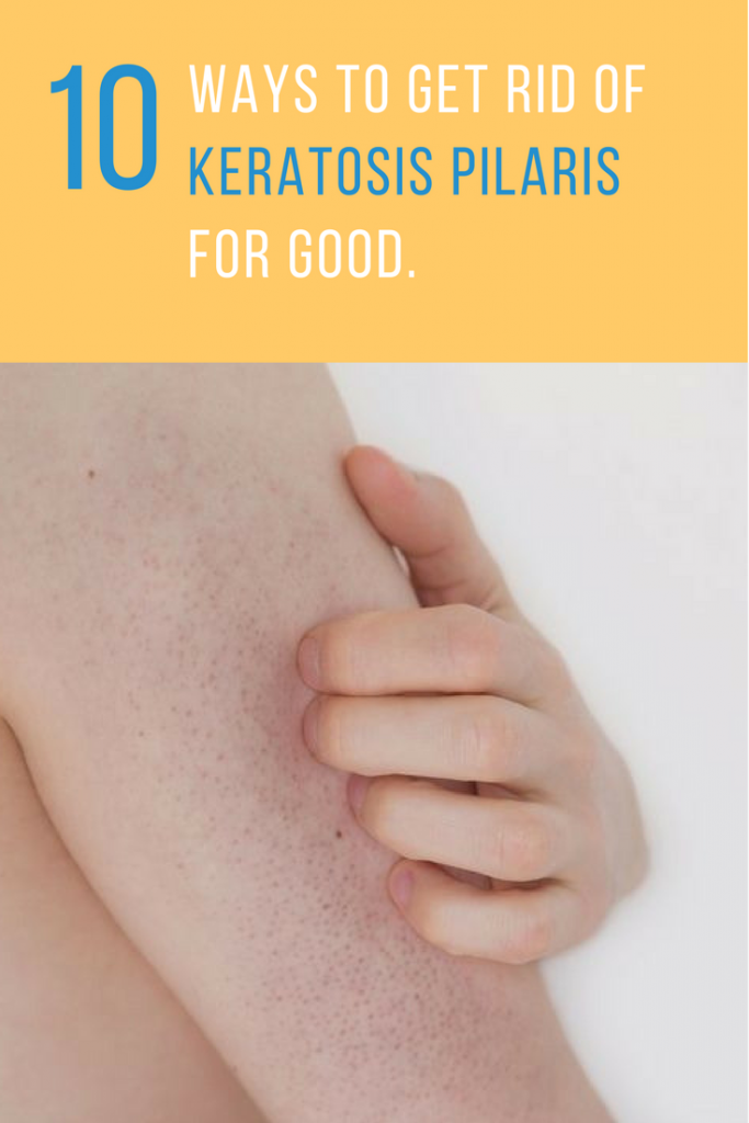 Keratosis Pilaris Treatment Ideas That Help Cure Chicken Skin