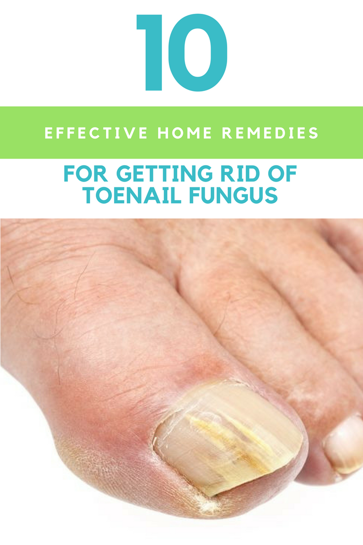 10 Effective Home Remedies For Getting Rid Of Toenail Fungus